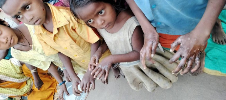 छत्तीसगढ़:- राष्ट्रपति के दत्तक पुत्रों का दंश:- अडसरा के केदाई पड़ो मोहल्ले में स्वास्थ्य संकट, प्रशासन बेखबर