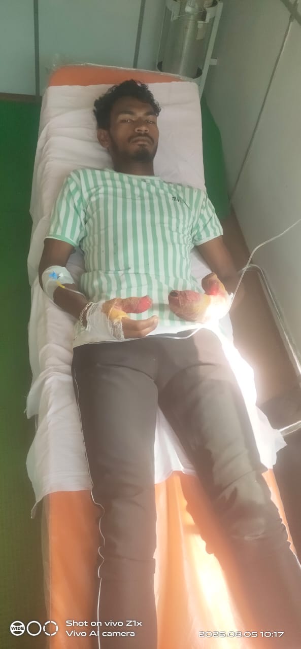 माओवादियों की साजिश का शिकार हुआ ग्रामीण, प्रेशर IED विस्फोट में दोनों हाथों में आई चोट।